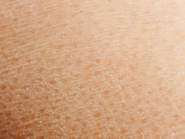 Clinisoothe+ and Dermatitis: How our award-winning product can help with symptoms.
