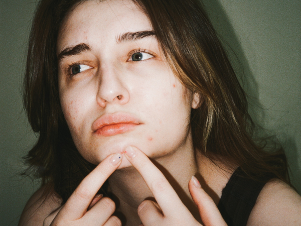 Should You Pop Your Spots? | Top Spot Picking Tips From a Skincare expert