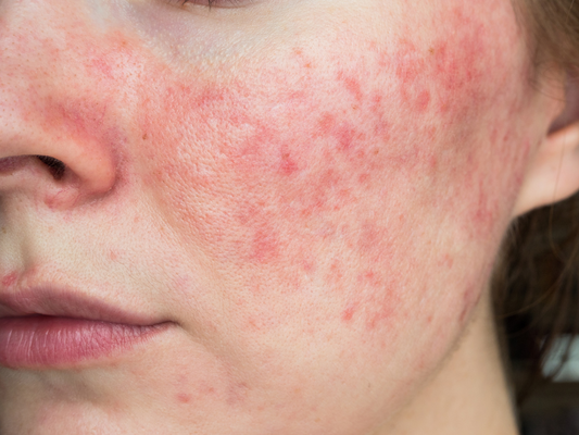 Rosacea: Expert Advice on Symptoms, Triggers & How to Calm Your Skin