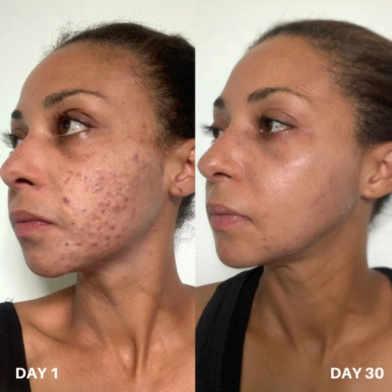 A Nutritionist’s Guide To Hormonal Acne