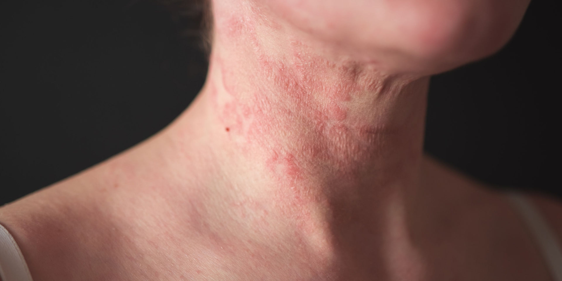 Understanding dermatitis