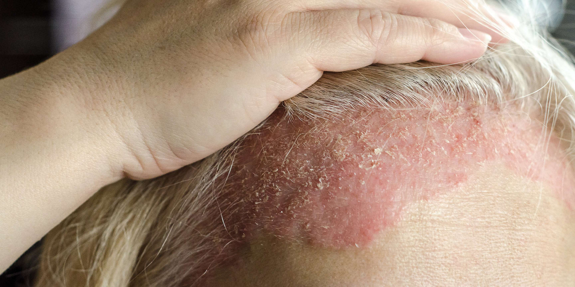 Understanding eczema