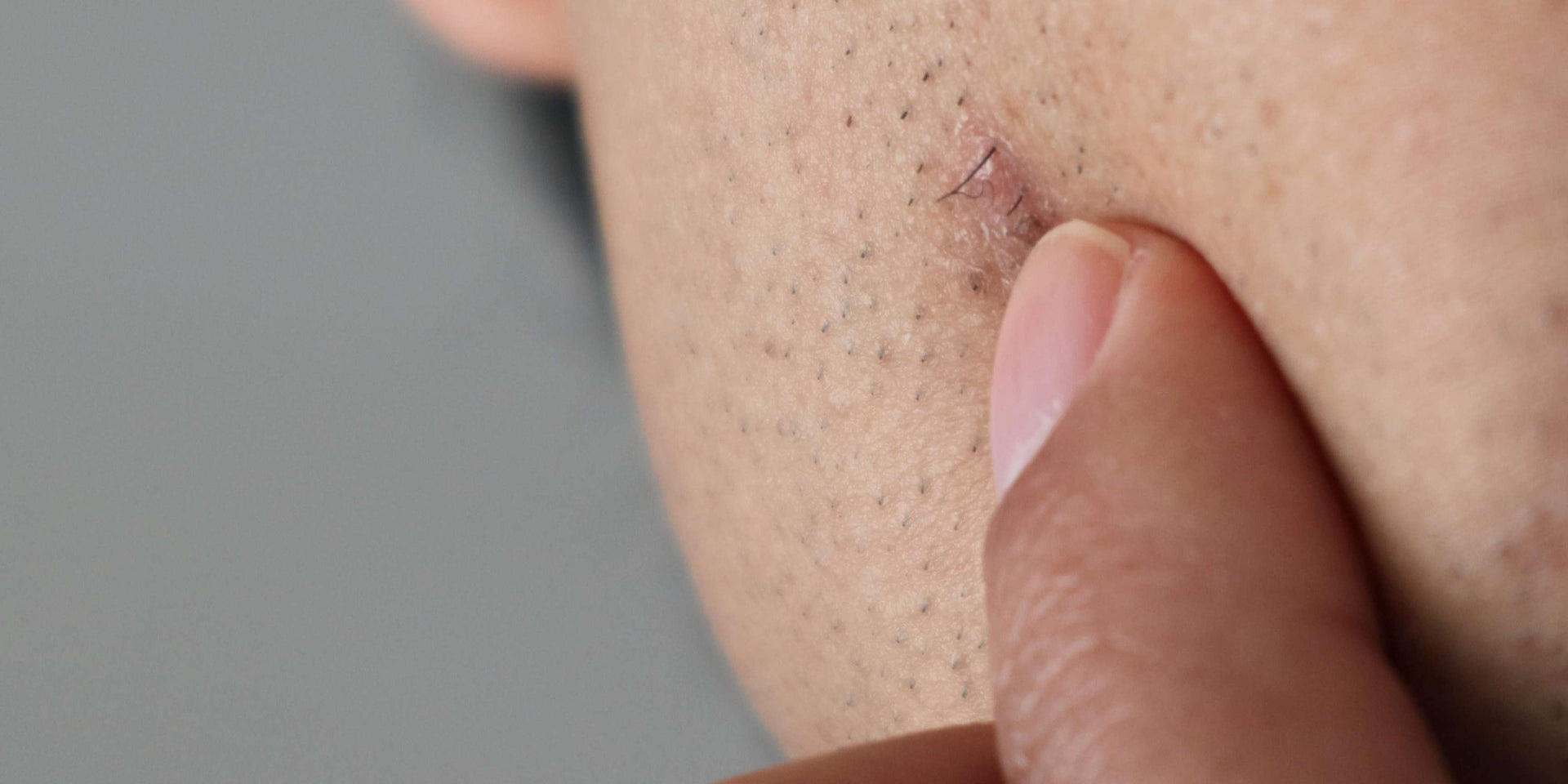 Understanding folliculitis