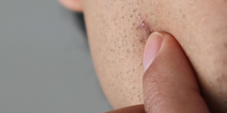 Understanding folliculitis