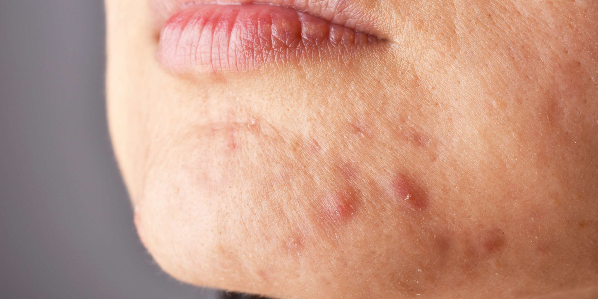 Understanding hormonal breakouts