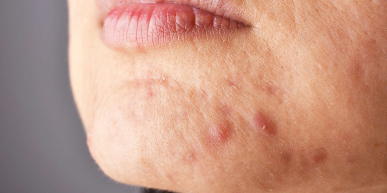 Understanding hormonal breakouts