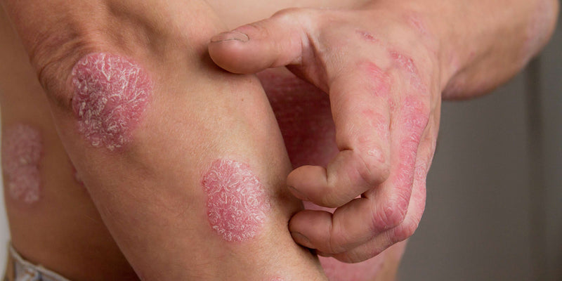 Psoriasis